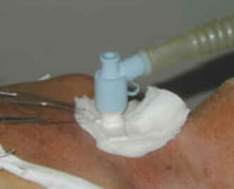 Traqueostomia Traqueostomia
