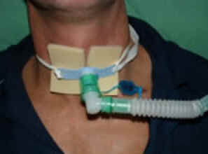 Traqueostomia Traqueostomia