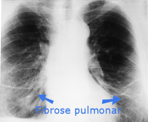 Asbestose