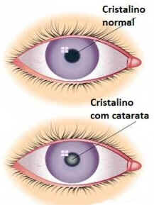 Catarata