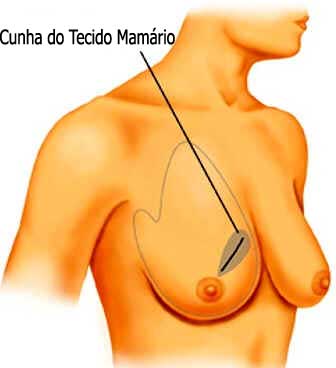 Cirurgia do Câncer de Mama