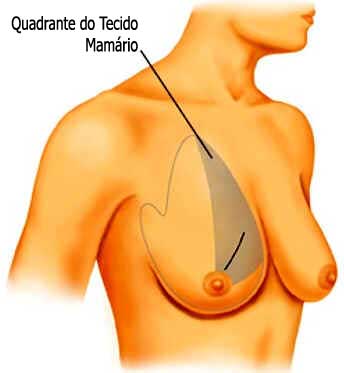 Cirurgia do Câncer de Mama