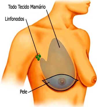 Cirurgia do Câncer de Mama