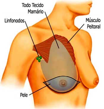 Cirurgia do Câncer de Mama