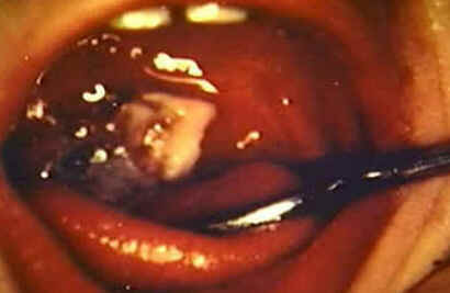 Difteria