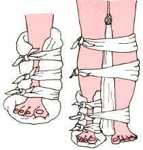 Fraturas