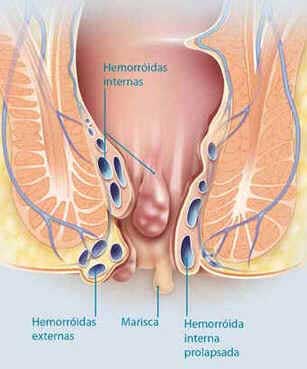 Hemorróidas Hemorróidas