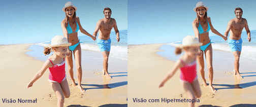 Hipermetropia