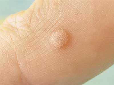 HPV
