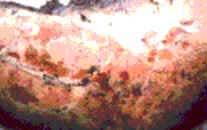 Queimaduras
