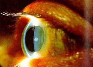 Retinopatia Retinopatia
