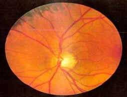 Retinopatia Retinopatia
