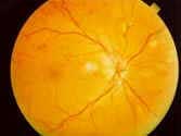 Retinopatia