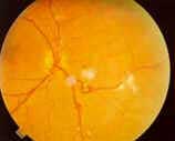 Retinopatia