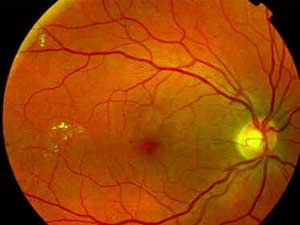 Retinopatia