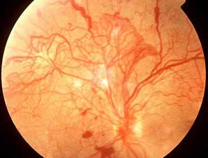 Retinopatia