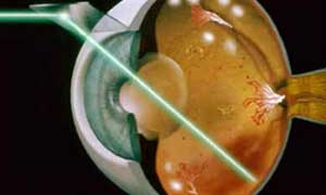 Retinopatia
