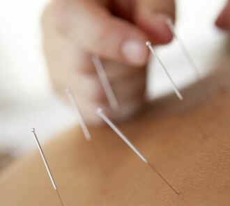 Acupuntura