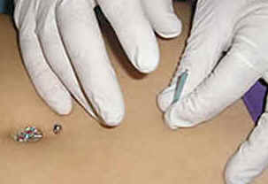 Acupuntura