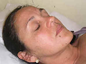 Acupuntura