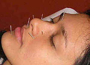 Acupuntura