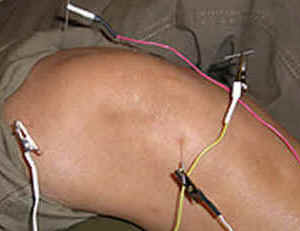 Acupuntura