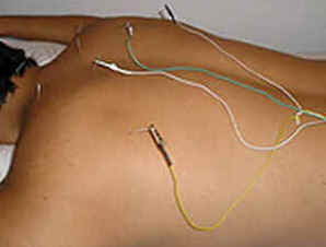 Acupuntura