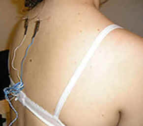 Acupuntura