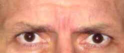 Botox