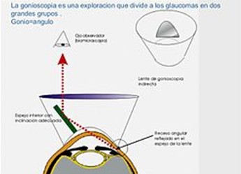 Gonioscopia Gonioscopia
