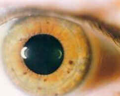 Iridologia