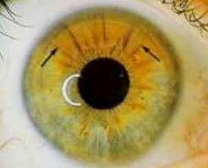 Iridologia