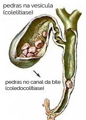 Vesícula Biliar