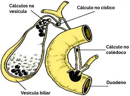 Vesícula Biliar