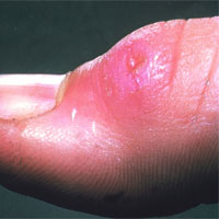 Tularemia