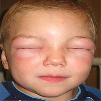 Angioedema