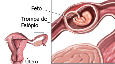 Gravidez nas Trompas