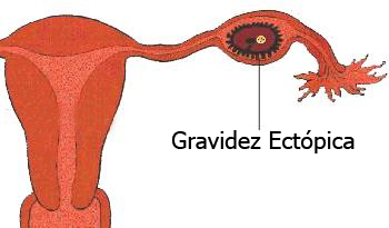 Gravidez nas Trompas