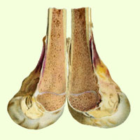 Osteomielite