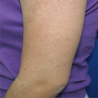 Queratose Pilar