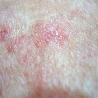Queratose Actínica