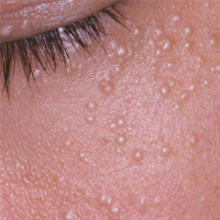 Siringoma