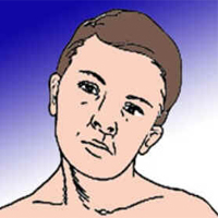 Torcicolo