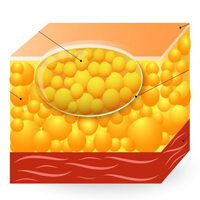 Lipoma