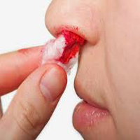 Epistaxe