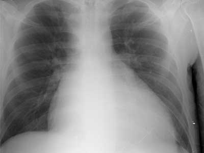 Cardiomegalia