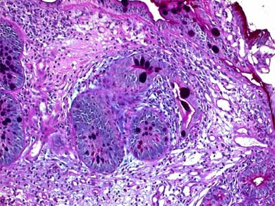Metaplasia