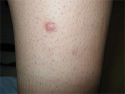 Dermatofibroma