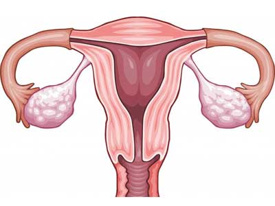 Adenomiose