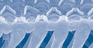 Otosclerose Otosclerose